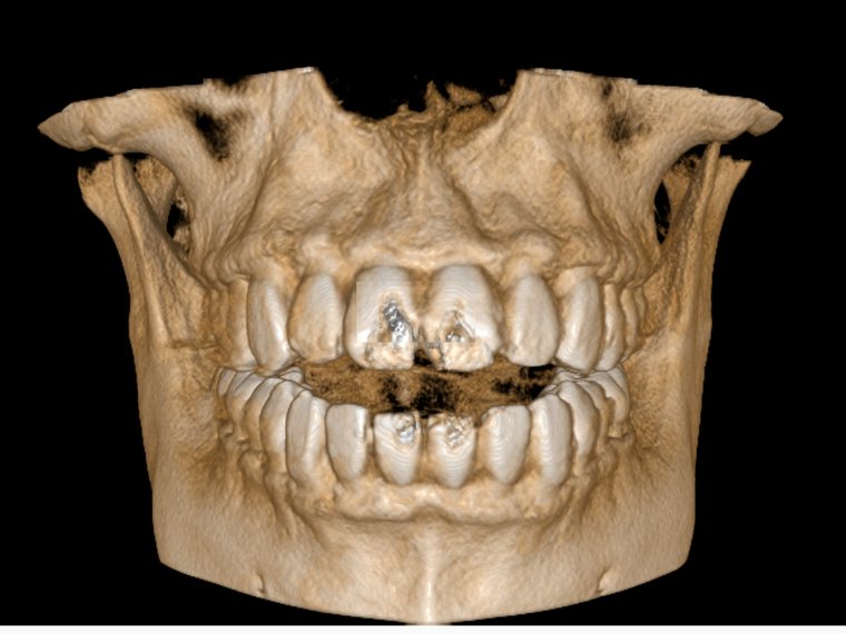 Reconstrução tridimensional da maxila e da mandíbula obtida por tomografia CBCT