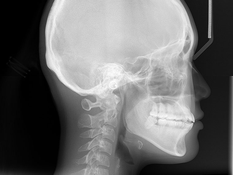 Telerradiografia de perfil, parte da documentação ortodôntica
