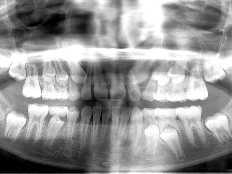Radiografia panorâmica em dentição mista, com os dentes permanentes em formação