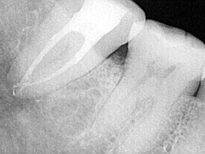 Radiografia periapical mostrando um dente com tratamento de canal e o osso ao redor
