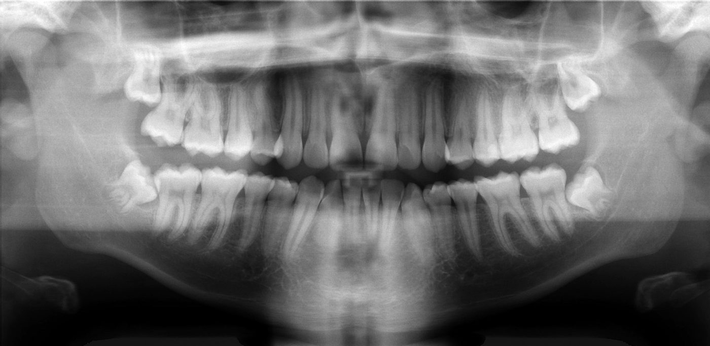 Radiografia panorâmica odontológica mostrando a arcada dentária completa